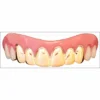 Swedia's Billy Bob Teeth - Gold Veneers
